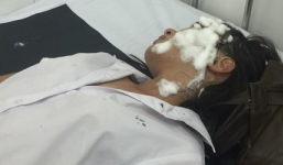 Mâu thuẫn tình ái, 2 nữ sinh viên bị kẻ lạ mặt tạt axit?