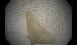 Hóc xương cá, một người đàn ông suýt tử vong