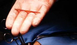 Phẫu thuật lấy dị vật thành công trong tim người đàn ông