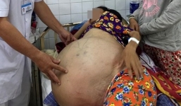 Phẫu thuật bóc tách khối u buồng trứng nặng đến 40 kg