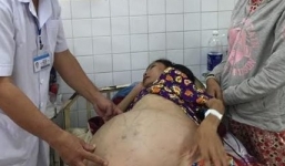 Người phụ nữ mang khối u buồng trứng 40kg suốt 10 năm