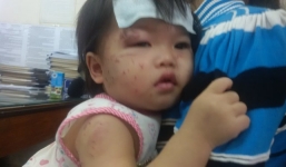 Bé 11 tháng tuổi bị bạn cắn, cấu nát mặt khi gửi ở nhà trẻ tư thục