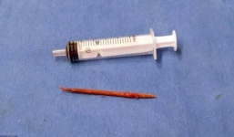 Hy hữu, người đàn ông bị tăm đâm thủng tim do đồ ăn vặt