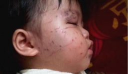 Bé gái bị bạn cào mặt: Trưởng phòng Đào tạo nói gì?