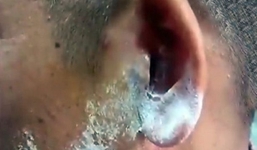 Bất cẩn nhỏ nhầm keo 502 vào tai lúc nửa đêm