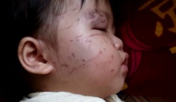 Bé 11 tuổi bị bạn cắn, cấu nát mặt: Phụ huynh bức xúc vì nhà trường thờ ơ