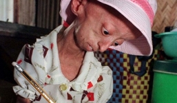 Bé gái 5 tuổi hóa bà lão vì bệnh lạ