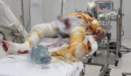 Cháy nhà, hai vợ chồng bỏng nặng toàn thân