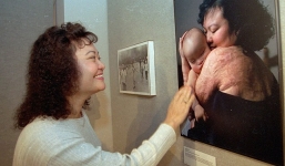 'Em bé napalm' - biểu tượng chiến tranh Việt Nam được điều trị laser miễn phí