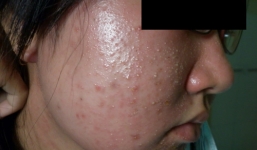 Hóa chất bảo quản vượt ngưỡng gây hại sức khỏe như thế nào?