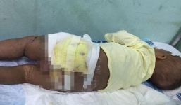 Mẹ đắp lá chữa nhọt, con bị nhiễm trùng máu, hoại tử da