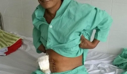 Cứu sống bệnh nhân nguy kịch vì nuốt tăm khi nhậu say