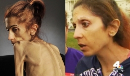 Hình ảnh mới của người phụ nữ “gầy trơ xương”, nặng 14kg