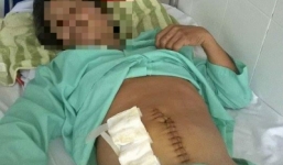 Suýt mất mạng vì nuốt tăm tre trong lúc nhậu say