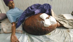 Chàng trai có khối u lớn nhất trong lịch sử y học