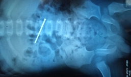 Bé 18 tháng tuổi súyt mất mạng do nuốt đinh dài 4,5cm vào bụng