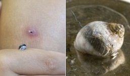 Bất ngờ phát hiện ốc sên trong...khối cục sưng tấy ở đầu gối