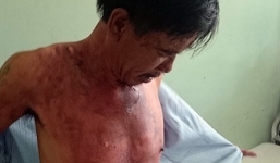 Vợ tạt cả nồi cháo đang sôi vào người chồng vì bị  đánh