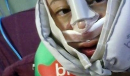 Đòi bồi thường 1 nghìn nhân dân tệ sau ca phẫu thuật khiến mũi bị lệch