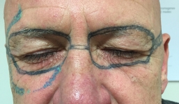 Người đàn ông bị xăm nguyên cặp kính lên mặt sau khi say xỉn