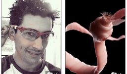 Chàng trai suýt mất mạng vì bị sán ổ làm trong não 