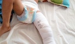 Bé trai 8 tuổi suýt mất mạng vì tưởng kíp nổ là đồ chơi