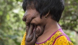 Tinh thần lạc quan của cô gái không có khuôn mặt suốt 21 năm