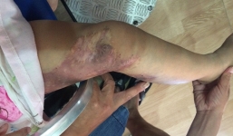 Cứu sống thành công bé gái bị hội chứng lạ - dị dạng tĩnh mạch