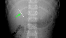 Bé trai 4 tuổi thủng thận do nuốt phải kẹp tóc dài