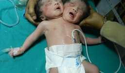 Hy hữu trường hợp bé sơ sinh có hai đầu ở Bangladesh