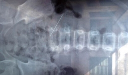 Bé gái bị kim khâu đâm xuyên bụng được cứu sống thành công 