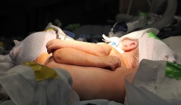 Phẫu thuật tách cặp song sinh liền ngực, khoang bụng thành công