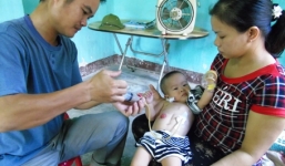 Bé trai hơn một tuổi không có hậu môn và teo thực quản