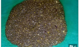 Phẫu thuật lấy 12.000 viên sỏi trong túi mật một người phụ nữ