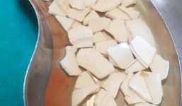 Người đàn ông nuốt 59 mảnh chén vỡ vào bụng