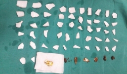 BV Bạch Mai phẫu thuật gắp 59 mảnh bát vỡ trong bụng bệnh nhân