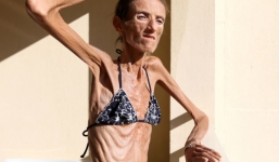 Cô gái chỉ còn da bọc xương sau quá trình giảm cân