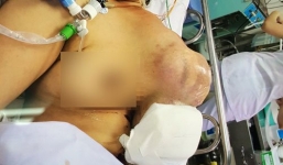 Phẫu thuật cắt khối u khổng lồ cứu sống bệnh nhân bị u xương ức