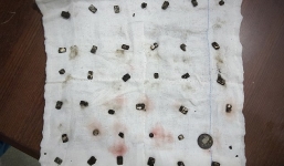 Gắp bỏ 29 viên nam châm trong bụng bé trai 3 tuổi