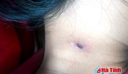 Bệnh lạ 'sốt mò' ở Hà Tĩnh là bệnh gì?