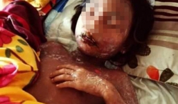 Huế: Bé gái suýt tử vong do dị ứng với nước ngọt