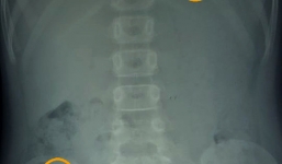 Quảng Bình: Phát hiện 7 chiếc kim khâu trong bụng bé gái 10 tuổi