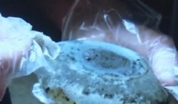 Bé trai bị nhiễm trùng thận vì bú sữa mẹ độn ngực silicon bị nấm mốc