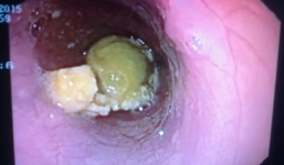 Nuốt mật heo sống, sản phụ suýt tử vong