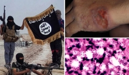 IS gieo rắc kí sinh trùng ăn thịt người, phá hủy nôi tạng