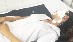 Nối lại tình cảm không thành, tạt axit vào người yêu cũ