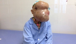 Cụ bà bị vỡ mắt do mang khối u khổng lồ che kín mặt