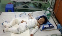 Ngã vào nồi nước sôi, bé gái 2 tuổi nguy kịch