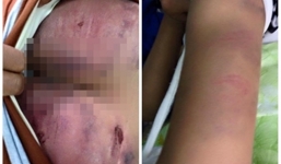 Bắc Giang: Bé gái 14 tuổi bị bố đánh phải nhập viện cấp cứu