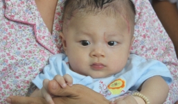 Bé trai bị đâm xuyên sọ phải phẫu thuật lần hai